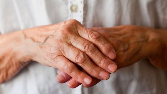реуматоидни артритис као узрок болова у зглобовима прстију